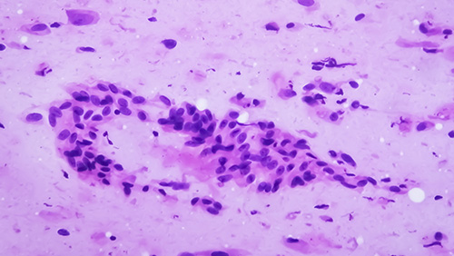 Photomicrograph showing Neurofibroma. Neurofibromatosis, is a genetic disorder, gene mutations.