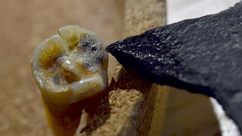 Un molare di Neanderthal risalente a 59 mila anni fa potrebbe rappresentare la più antica prova di un intervento odontoiatrico: secondo i ricercatori, la cavità osservata sul dente sarebbe il risultato di una rimozione intenzionale del tessuto cariato. Una scoperta che anticipa di decine di migliaia di anni le prime evidenze note di cure dentali nei Sapiens.