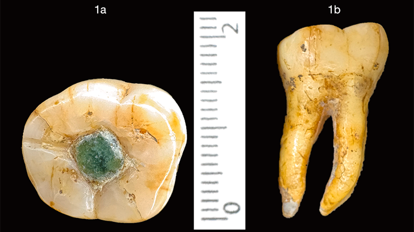Uno studio sul Journal of Archaeological Science Reports descrive un molare Maya con un intarsio in giada fissato mediante un cemento naturale. La scoperta potrebbe rappresentare la più antica evidenza di un'otturazione dentale a scopo terapeutico.