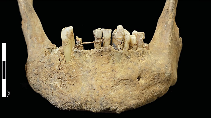 Un filo d’oro applicato ai denti tra il XV e il XVII secolo potrebbe rappresentare il più antico caso di odontoiatria restaurativa mai documentato in Scozia. Lo rivela uno studio pubblicato sul British Dental Journal, che descrive il ritrovamento, ad Aberdeen, di una legatura in lega d’oro probabilmente utilizzata per stabilizzare un dente mobile o sostenere una protesi. Realizzata forse da un orafo e riservata a un individuo di alto status sociale, la scoperta testimonia come tecniche di restauro dentale fossero già praticate secoli prima della nascita dell’odontoiatria moderna.