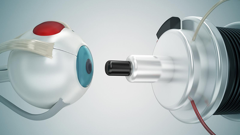 Due interventi eseguiti a Padova riaccendono la speranza per chi soffre di maculopatia avanzata. Grazie a innovative lenti intraoculari telescopiche, alcuni pazienti ipovedenti hanno recuperato parte della capacità visiva, con benefici concreti nella vita quotidiana. Tech2Doc approfondisce questa tecnica e le altre novità che stanno cambiando la cura della malattia.